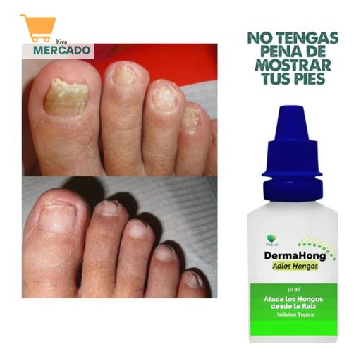 DERMAHONG Anti-Hongos 3X1 ELIMINA HONGOS, Picazón y Mal Olor