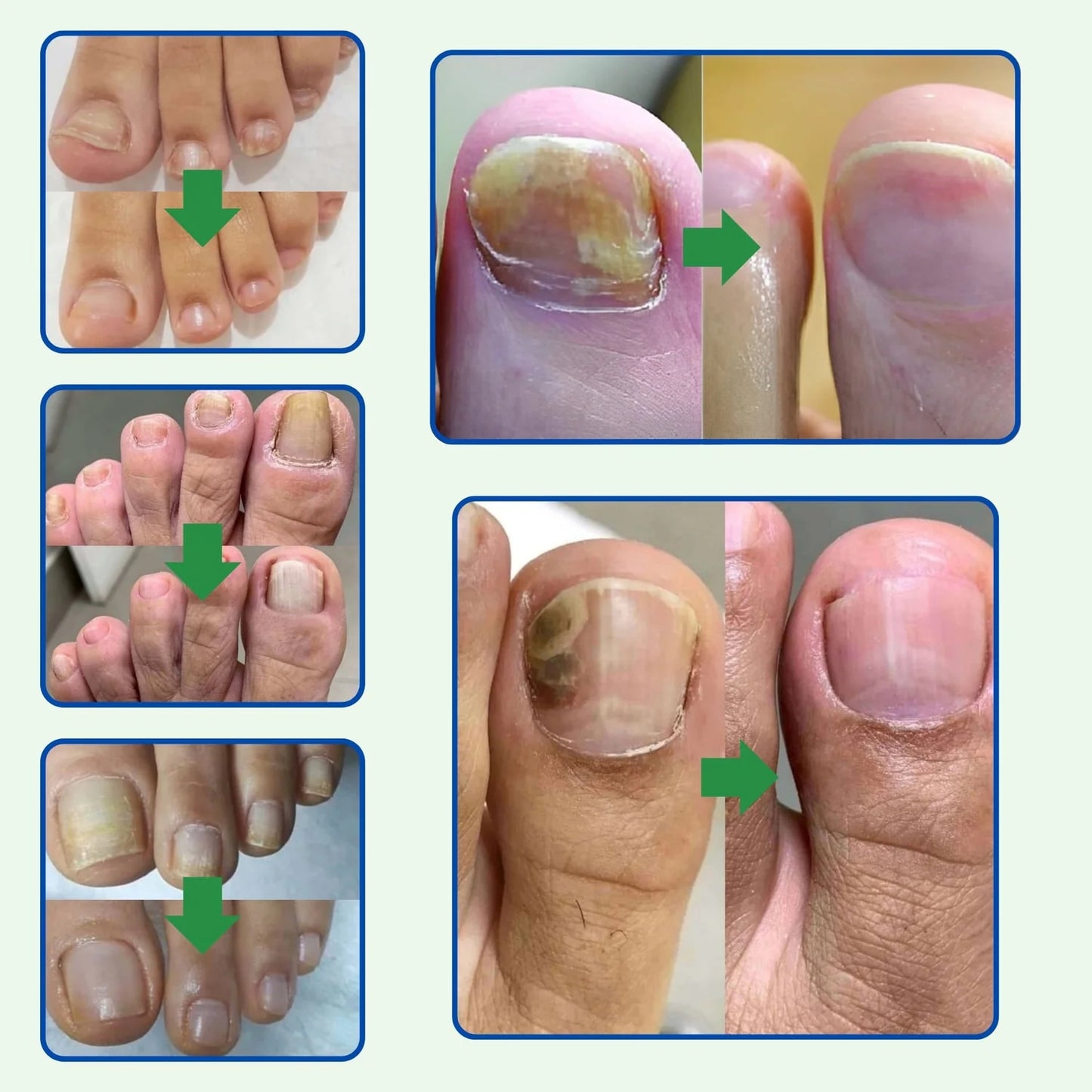 TRATAMIENTO ANTI HONGOS 100% NATURAL 7 DÍAS